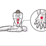 ما هو الإنعاش القَلبي الرئوي CPR