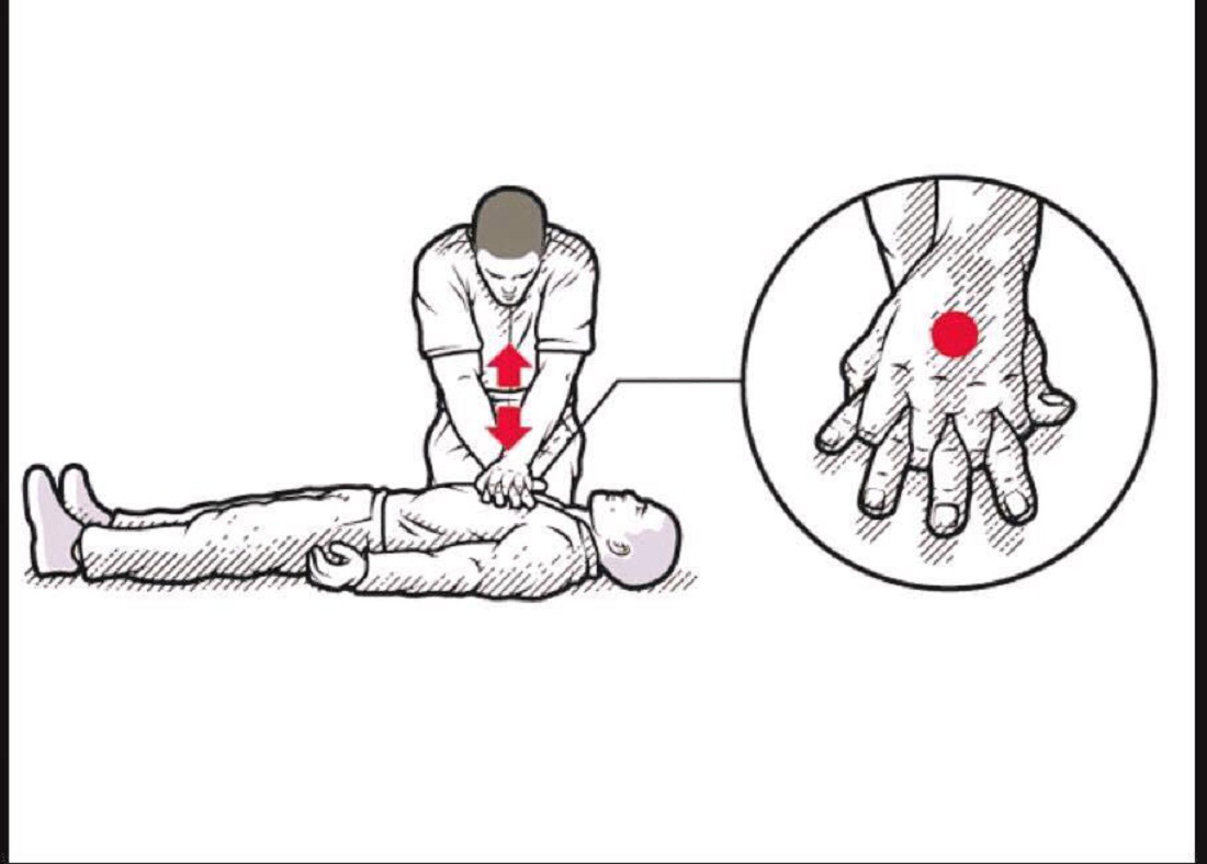 ما هو الإنعاش القَلبي الرئوي CPR