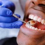 أسباب الخراج في الأسنان وعلاجه