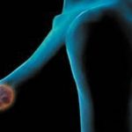 هل الورم الليفي في الثدي يسبب ألم في الإبط