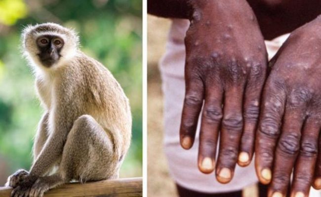 كم عدد المصابين بجدري القرود في العالم