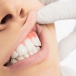 علاج نزول اللثة وتعري الأسنان