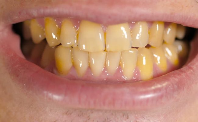 تفسير رؤية الأسنان الصفراء في المنام ومعناه بالتفصيل - مخزن