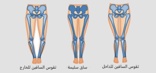 علاج تقوس الساقين للخارج الأسباب التشخيص المبكر والأعراض