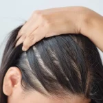 علاج فراغات الشعر بالزيوت والطرق الطبيعية والطبية مجرب ومضمون